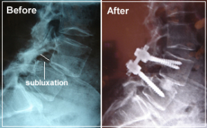Spinal Lumbar Procedure - Trans-Foraminal Interbody Fusion