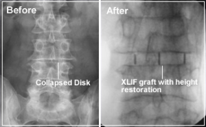 Spinal Lumbar Procedure - Direct lateral interbody fusion
