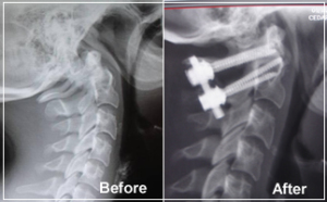 cervical spine procedures- before and after posterior cervical fusion