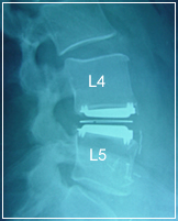 Spinal Lumbar Procedure - Artificial disk replacement