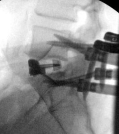Xray: Postsurgery