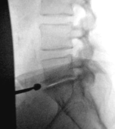 Xray: Presurgery